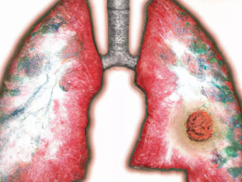 Researchers find why immunotherapy doesn't work well for lung cancer treatment